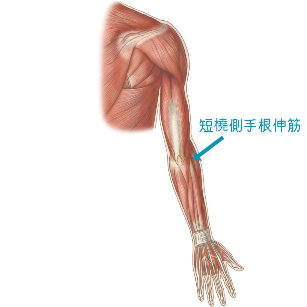 テニス肘の原因筋である短撓側手根伸筋