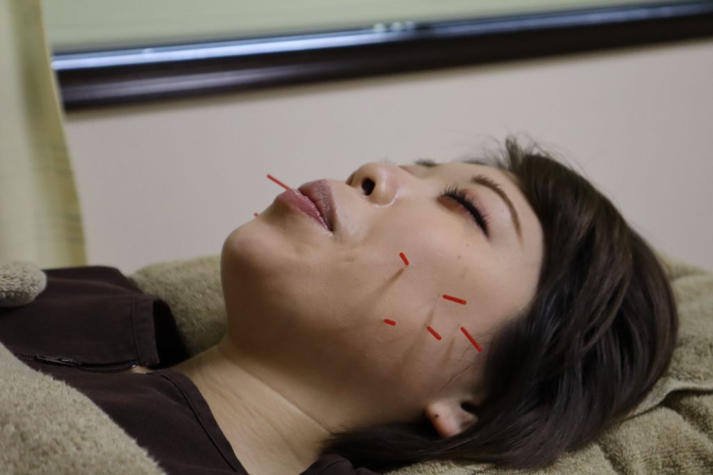 泉町鍼灸整骨院では、ニキビの予防・緩和には美容鍼でご対応