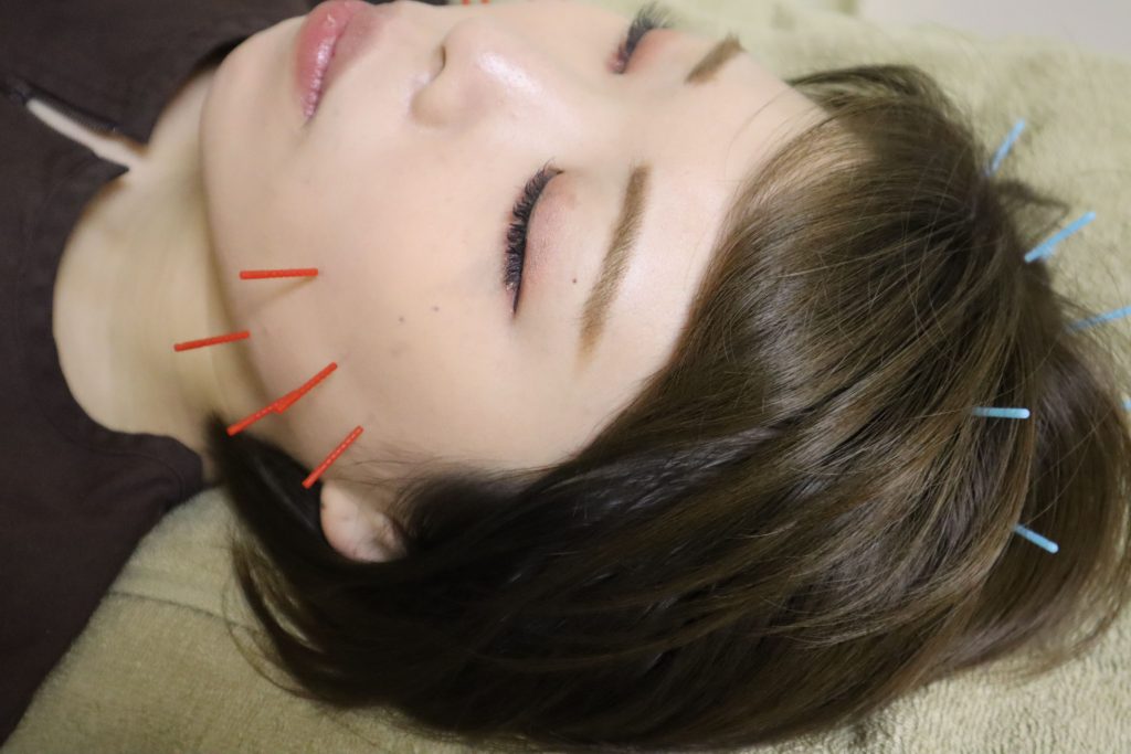 泉町鍼灸整骨院ではシミへのケアは美容鍼でご対応しております。